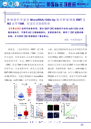 肿瘤源性外泌体 MicroRNA-106b-5p 激活肿瘤细胞 EMT 及 M2 亚型 TAM，促进结直肠癌转移