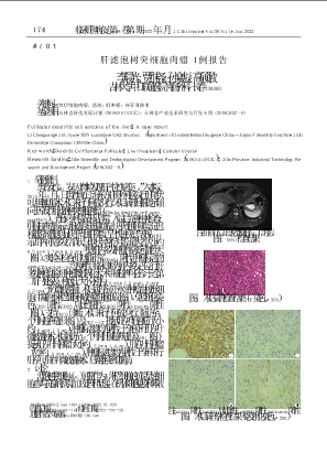 肝滤泡树突细胞肉瘤1例报告