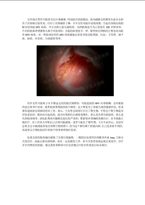 宫颈菜花状赘生物图片.docx