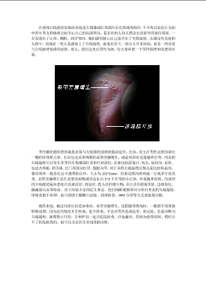 男性假疣和真疣的区别图.docx