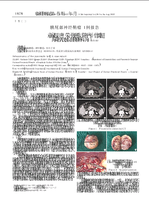 胰尾部神经鞘瘤1例报告.pdf