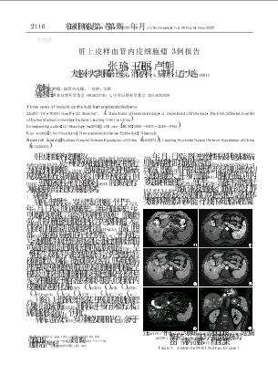 肝上皮样血管内皮细胞瘤3例报告.pdf